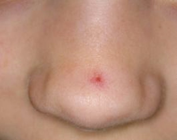 spider angioma pictures 7