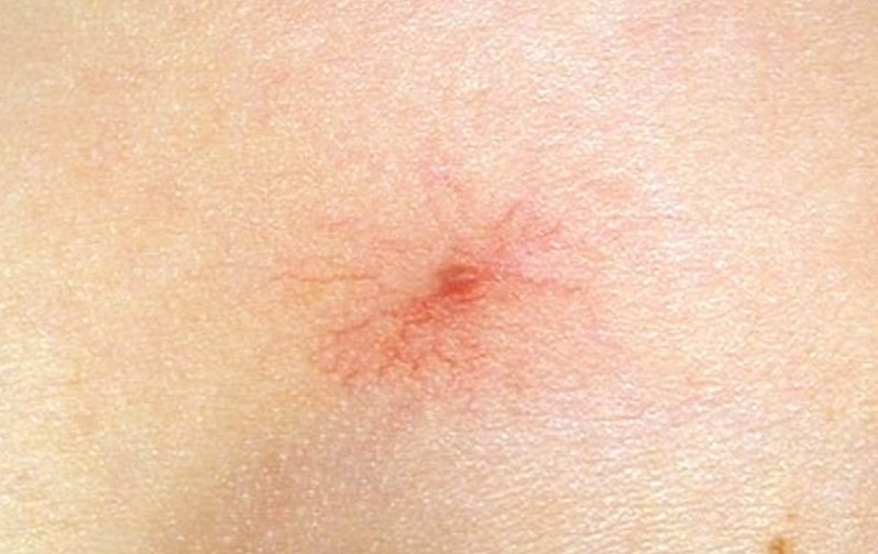 spider angioma pictures