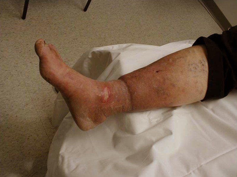 Venous Stasis Ulcer - Pictures, Symptoms, Causes, Treatment - (2021