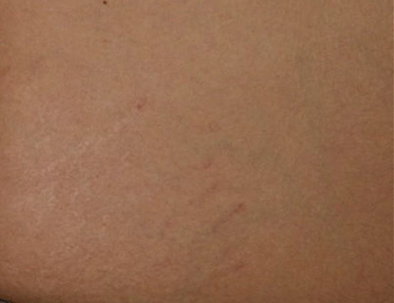 bartonella rash pictures 2