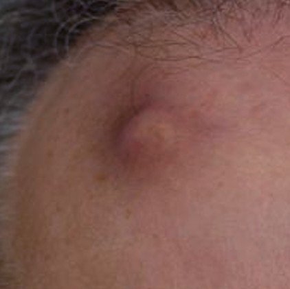 Healthool Epidermoid Cyst - Pictures, Removal, Symptoms ...