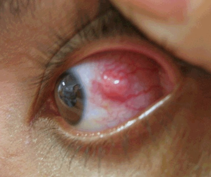 episcleritis pictures 3