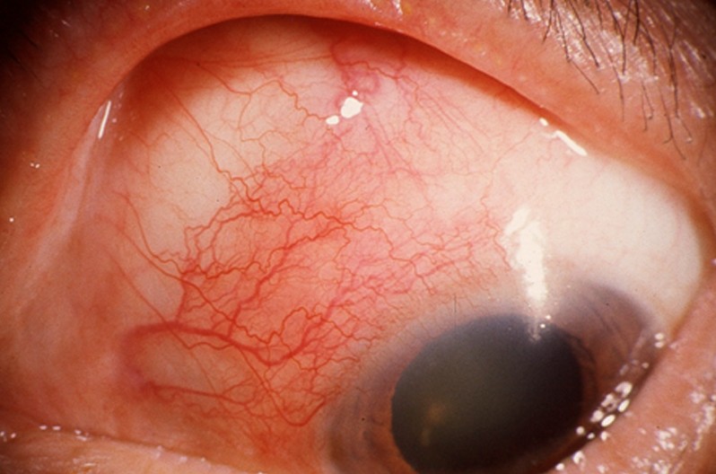 episcleritis pictures 4