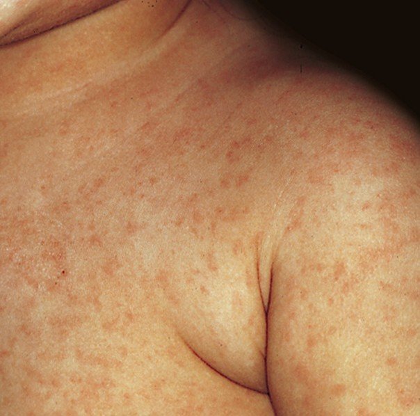 german measles pictures 4