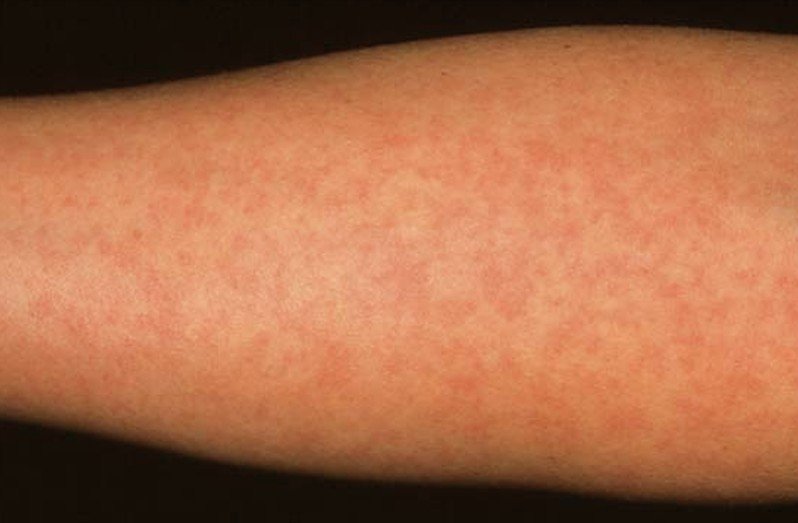 Healthool German Measles - Pictures, Symptoms, Causes, Treatment