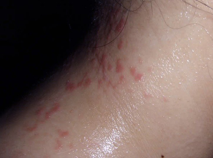 itchy-neck-pictures-symptoms-treatment-rash-causes-december-2021