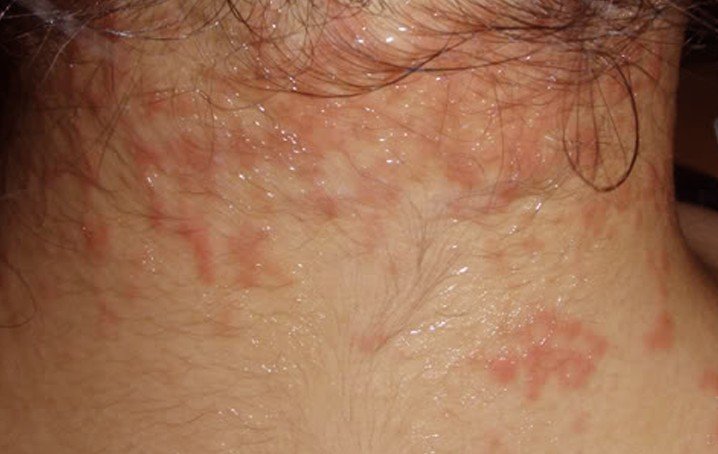 Healthool Itchy Neck Pictures Symptoms Treatment Rash Causes