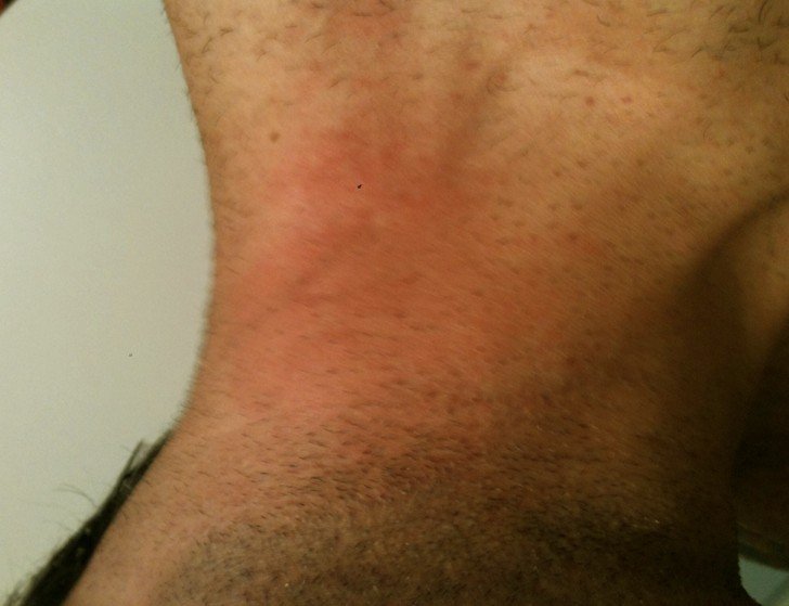 Red Dry Itchy Rash On Neck