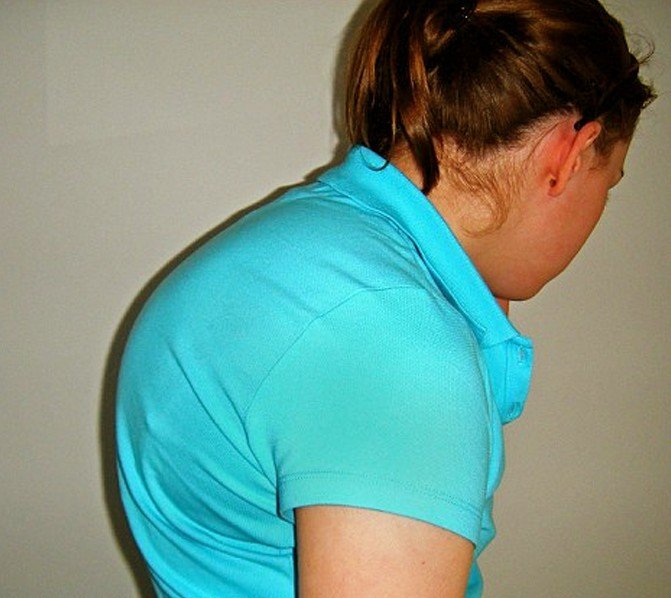 Kyphosis Types Symptoms Causes Diagnosis Pictures Treatment Updated