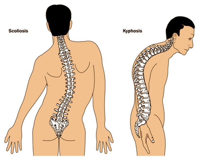 What Is Kyphosis Mean