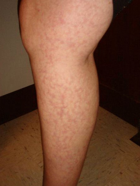 Livedo Reticularis Pictures Symptoms Diagnosis Causes Treatment