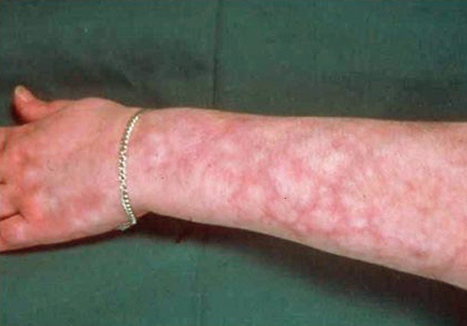 Livedo Reticularis Pictures Symptoms Diagnosis Causes Treatment 2018 Updated 