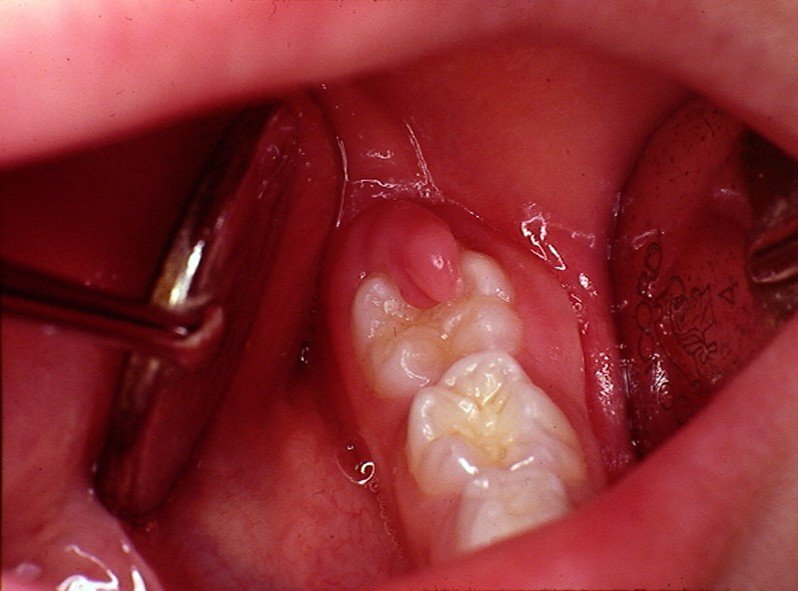 Pericoronitis - Pictures, Treatment, Symptoms, Causes 