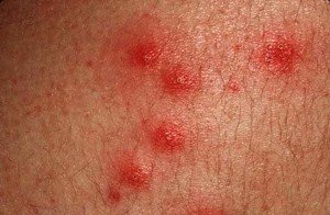 👉 Pseudomonas Folliculitis - Symptoms, Treatment, Pictures, Causes ...