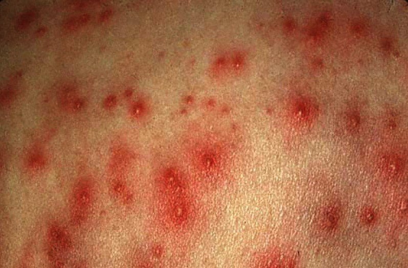 Pseudomonas Folliculitis - Symptoms, Treatment, Pictures, Causes