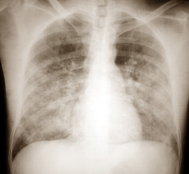 pulmonary edema pictures 2