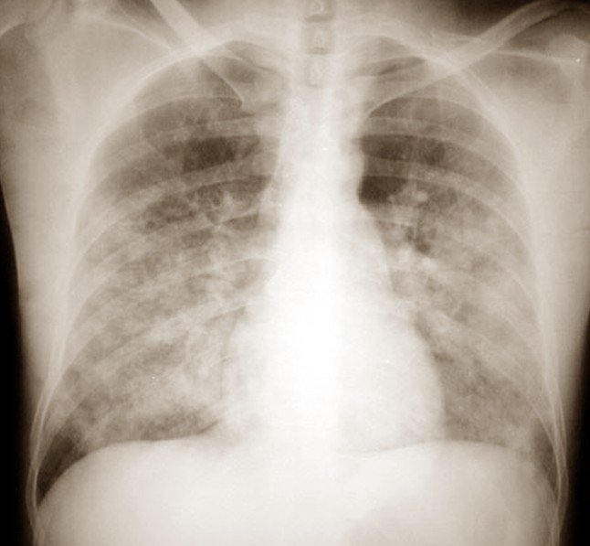 pulmonary edema