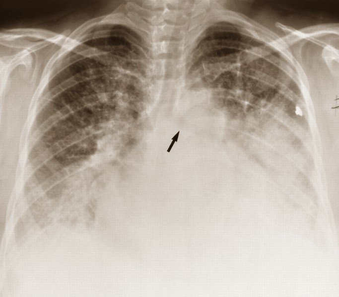 pulmonary edema lung sounds