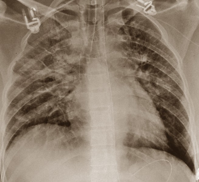 pulmonary edema pictures