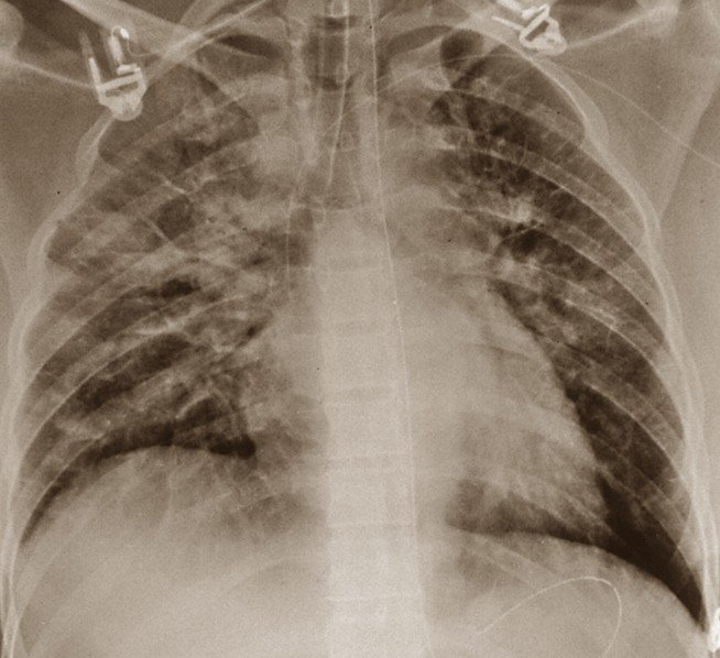 Pulmonary Edema - Pictures, Symptoms, Treatment, Causes, Diagnosis