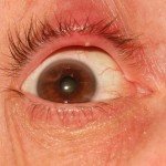 👉 Stye - Pictures, Contagious, Symptoms, Causes, Treatment (November 2021)