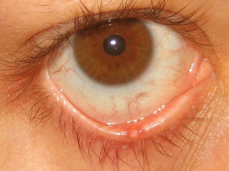 Stye Pictures Contagious Symptoms Causes Treatment 2018 Updated 