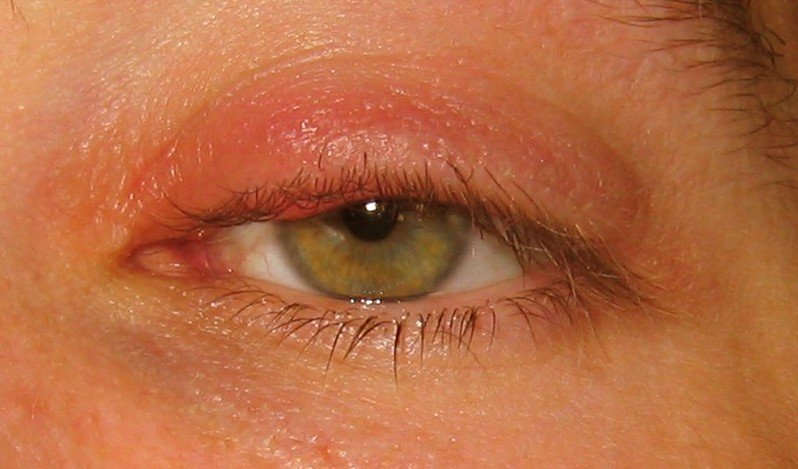 Stye Pictures Contagious Symptoms Causes Treatment 2018 Updated 