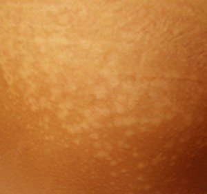 👉 Tinea Versicolor - Pictures, Contagious, Symptoms, Treatment ...