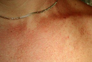 👉 Tinea Versicolor - Pictures, Contagious, Symptoms, Treatment ...