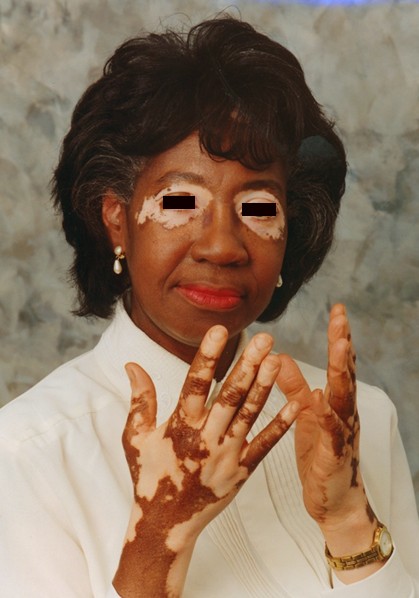 vitiligo pictures 3