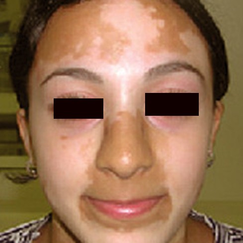 vitiligo pictures 5