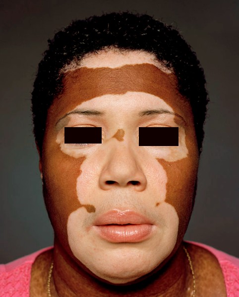 vitiligo pictures
