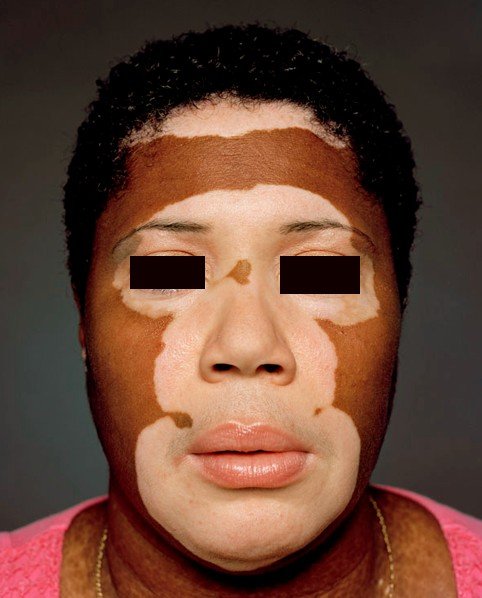 vitiligo universalis