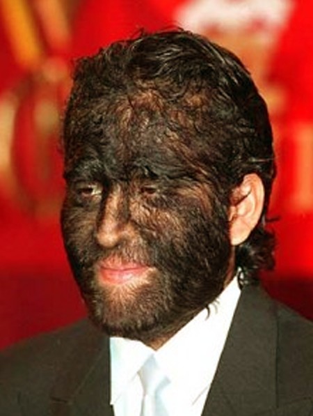 hypertrichosis pictures 2