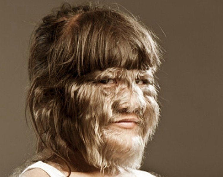 Healthool Hypertrichosis - Symptoms, Causes, Treatment, Pictures