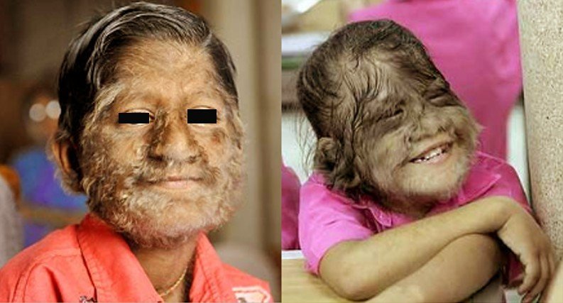 Healthool Hypertrichosis - Symptoms, Causes, Treatment, Pictures