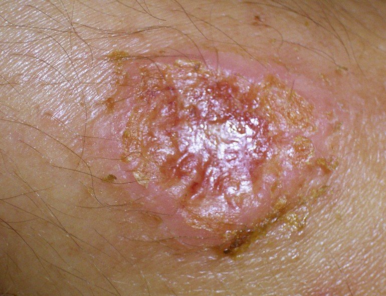 Leishmaniasis - Pictures, Symptoms, Treatment, Life Cycle, Causes