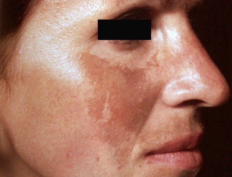 Dark Spots on Face (Melasma): Causes and Treatment