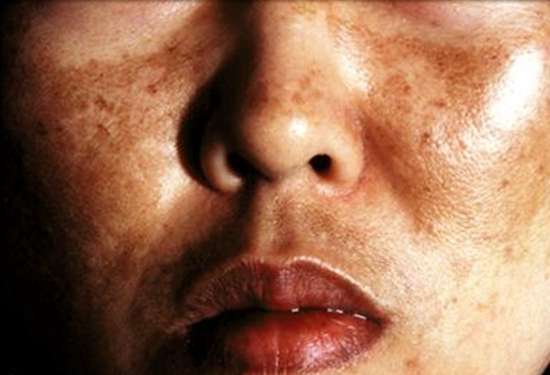 Melasma - Treatment, Pictures, Symptoms, Causes - (2018 