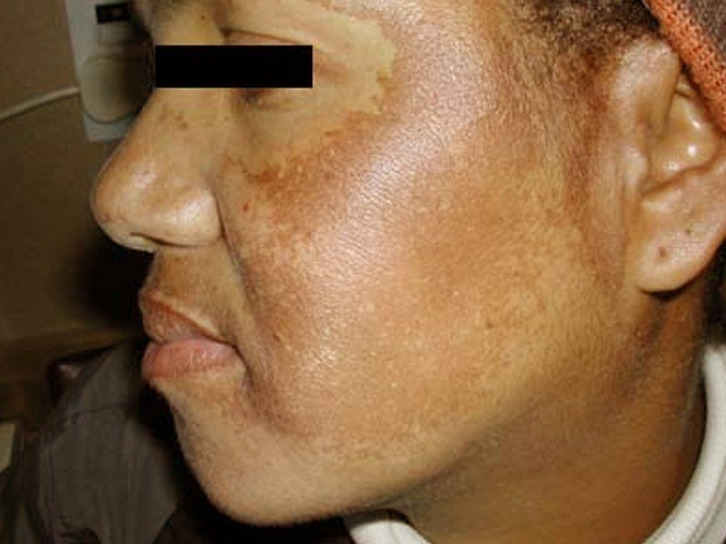 facial photo Melasma and