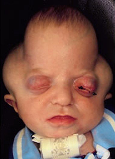 Healthool Pfeiffer syndrome - Pictures, Types, Symptoms, Causes