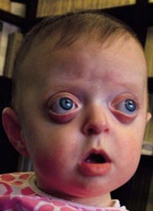 👉 Pfeiffer syndrome - Pictures, Types, Symptoms, Causes, Treatment ...