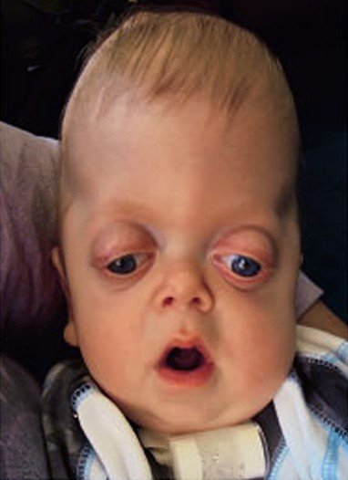 Pfeiffer syndrome - Pictures, Types, Symptoms, Causes, Treatment