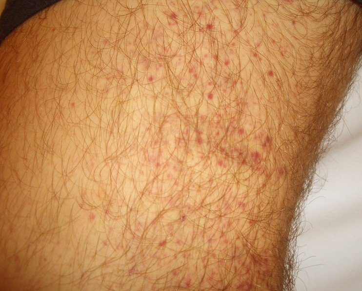 Purpura Pictures Causes Symptoms And Treatment 2018 Updated