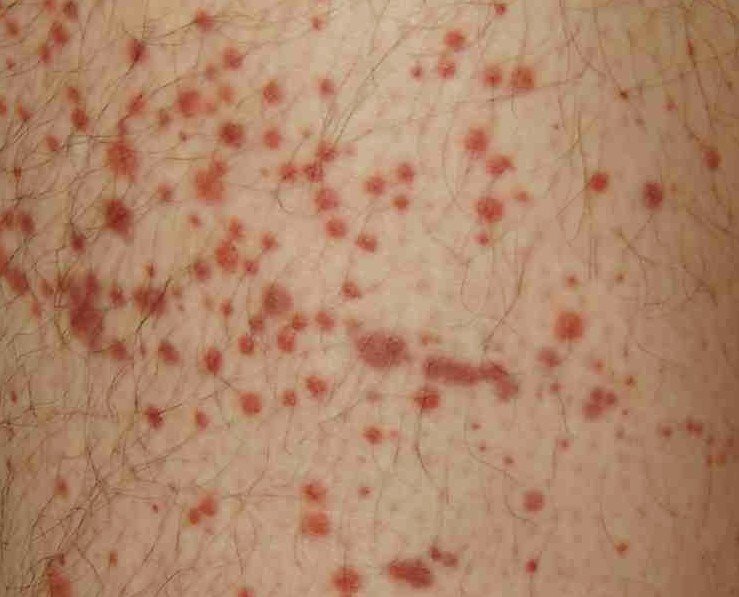 purpura-pictures-causes-symptoms-and-treatment-november-2021