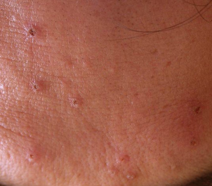 Sebaceous Hyperplasia Pictures Removal Symptoms Treatment Causes 2018 Updated 