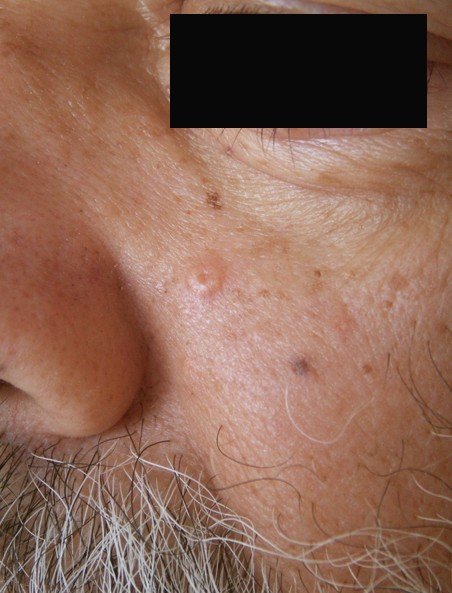 Sebaceous Hyperplasia Pictures Removal Symptoms Treatment Causes 2018 Updated 