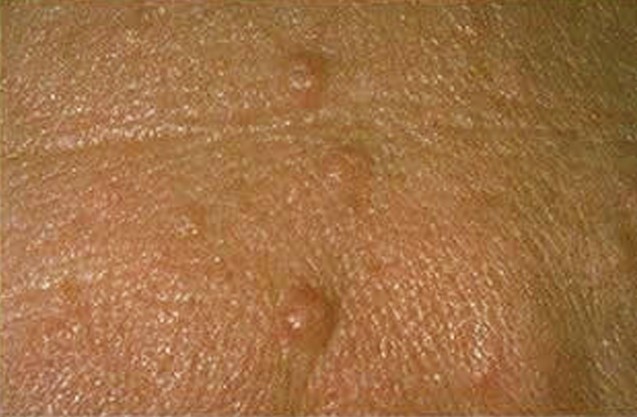 sebaceous hyperplasia pictures