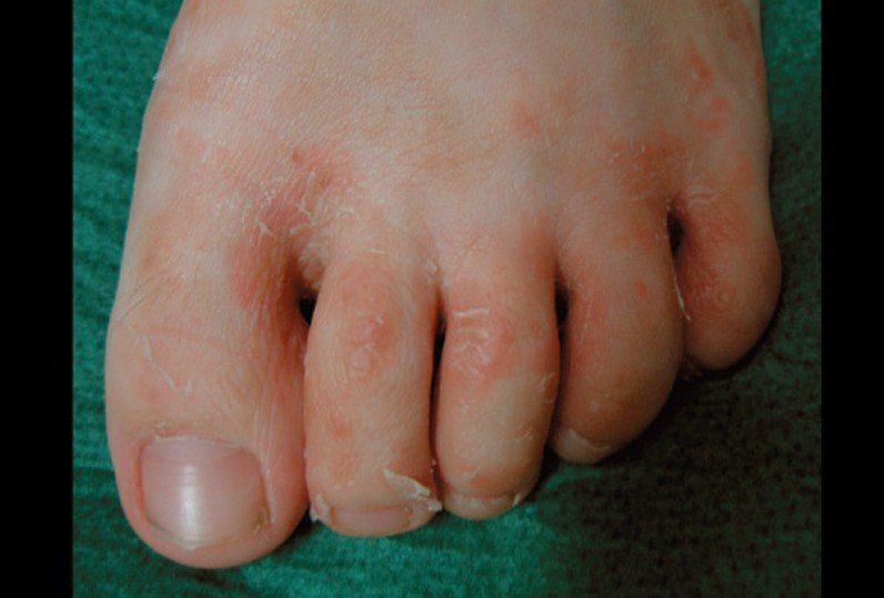 Tinea Pedis Treatment Pictures Symptoms And Causes 2018 Updated