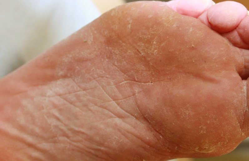 How To Treat Tinea On Toes